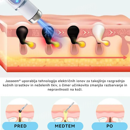 𝐉𝐚𝐬𝐬𝐞𝐞𝐦® Medicinski laserski pisalo 💕 (Poganja ga CO₂ laserska tehnologija – učinkovito odstranjuje znamenja, bradavice, kožne izrastke, pigmentne madeže in druge kožne nepravilnosti) 🔥