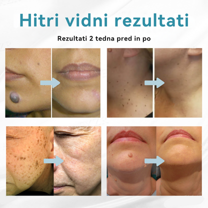 𝐉𝐚𝐬𝐬𝐞𝐞𝐦® Medicinski laserski pisalo 💕 (Poganja ga CO₂ laserska tehnologija – učinkovito odstranjuje znamenja, bradavice, kožne izrastke, pigmentne madeže in druge kožne nepravilnosti) 🔥