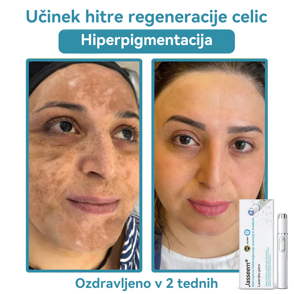 𝐉𝐚𝐬𝐬𝐞𝐞𝐦® Medicinski laserski pisalo 💕 (Poganja ga CO₂ laserska tehnologija – učinkovito odstranjuje znamenja, bradavice, kožne izrastke, pigmentne madeže in druge kožne nepravilnosti) 🔥