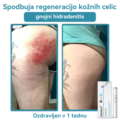 𝐉𝐚𝐬𝐬𝐞𝐞𝐦® Medicinski laserski pisalo 💕 (Poganja ga CO₂ laserska tehnologija – učinkovito odstranjuje znamenja, bradavice, kožne izrastke, pigmentne madeže in druge kožne nepravilnosti) 🔥