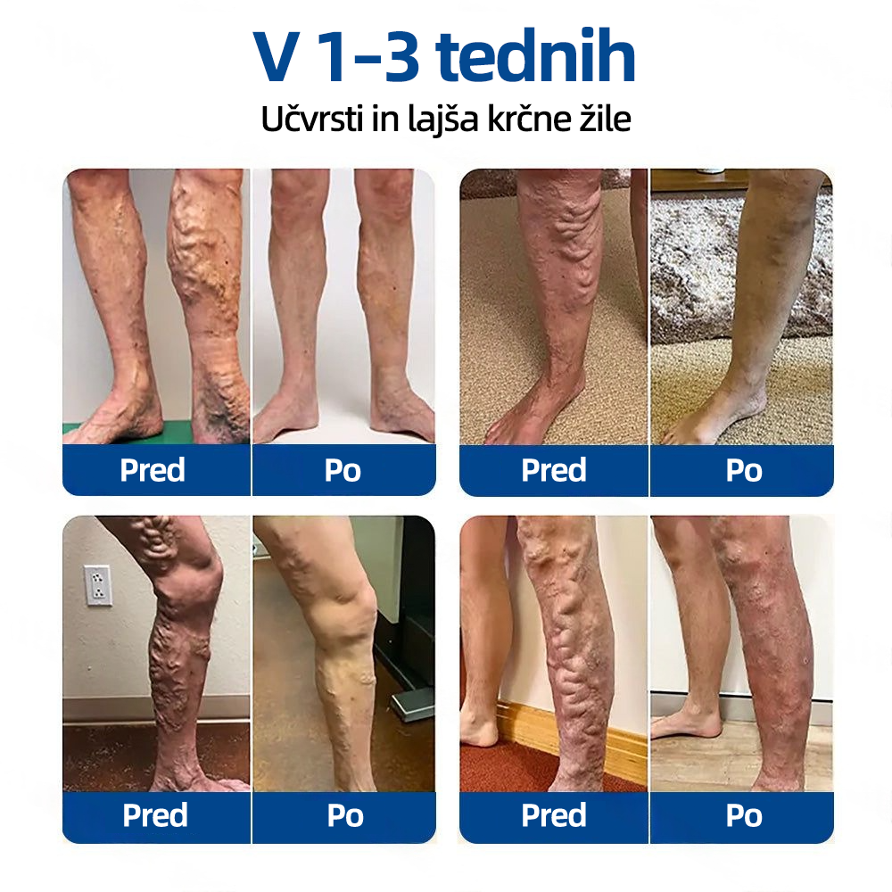 🛡️𝐅𝐥𝐨𝐫𝐢𝐬𝐦𝐚® 💕 Microneedle obliž klinične kakovosti z diosminom in hesperidinom — Napredna zeliščna formula, zasnovana za ciljno delovanje proti pajkastim in krčnim žilam ter za lajšanje občutka težkih in utrujenih nog. 👩‍⚕️