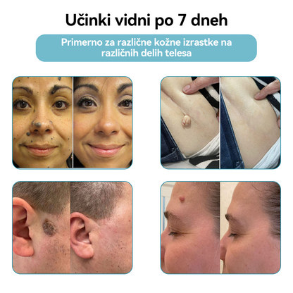 𝐉𝐚𝐬𝐬𝐞𝐞𝐦® Medicinski laserski pisalo 💕 (Poganja ga CO₂ laserska tehnologija – učinkovito odstranjuje znamenja, bradavice, kožne izrastke, pigmentne madeže in druge kožne nepravilnosti) 🔥