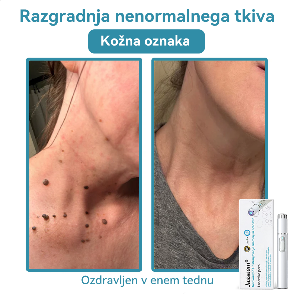 𝐉𝐚𝐬𝐬𝐞𝐞𝐦® Medicinski laserski pisalo 💕 (Poganja ga CO₂ laserska tehnologija – učinkovito odstranjuje znamenja, bradavice, kožne izrastke, pigmentne madeže in druge kožne nepravilnosti) 🔥
