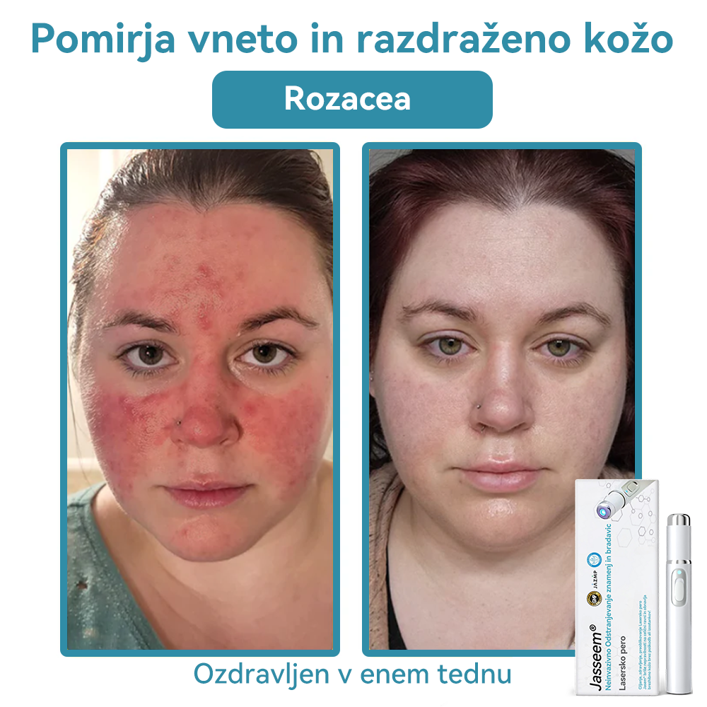 𝐉𝐚𝐬𝐬𝐞𝐞𝐦® Medicinski laserski pisalo 💕 (Poganja ga CO₂ laserska tehnologija – učinkovito odstranjuje znamenja, bradavice, kožne izrastke, pigmentne madeže in druge kožne nepravilnosti) 🔥